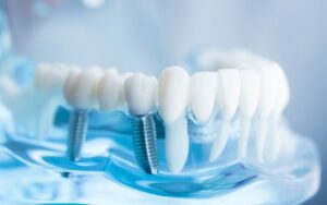 ایمپلنت دندان چیست
