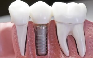 ایمپلنت دندان ها