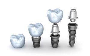 ساختار ایمپلنت دندان