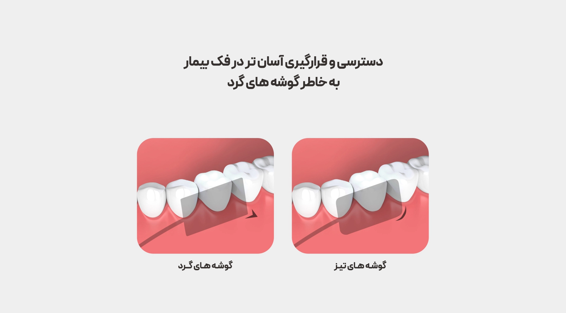 سنسور RVG وودپیکر مدل i-Sensor