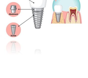 - اباتمنتها بر اساس معیارهایی مانند : 1.نوع اتصال (داخلی یا خارجی)، 2.مواد (تیتانیوم، زیرکونیا، سرامیک و غیره)، 3.روش ساخت (آماده یا سفارشی)، 4. روش نگهداری پروتز (چسب یا پیچ) طبقهبندی میشوند.