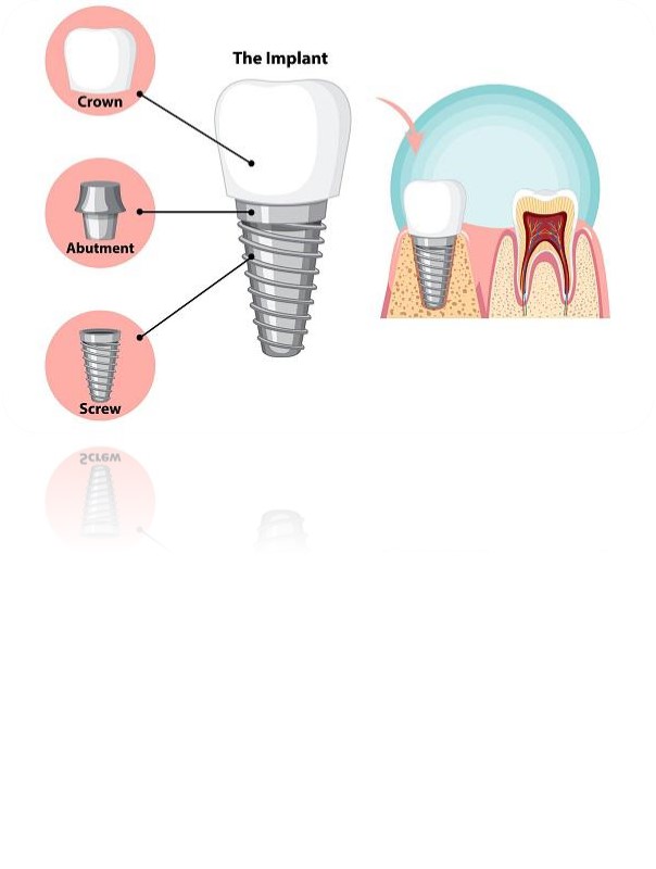 - اباتمنتها بر اساس معیارهایی مانند : 1.نوع اتصال (داخلی یا خارجی)، 2.مواد (تیتانیوم، زیرکونیا، سرامیک و غیره)، 3.روش ساخت (آماده یا سفارشی)، 4. روش نگهداری پروتز (چسب یا پیچ) طبقهبندی میشوند.